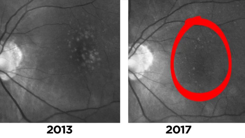 Two Cases of Disappearing Drusen in Patients with AMD